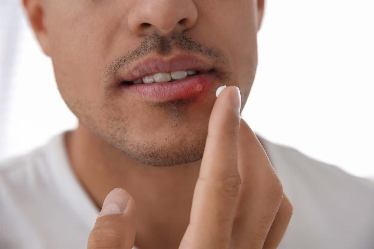 oral-herpes-1200x800.jpg