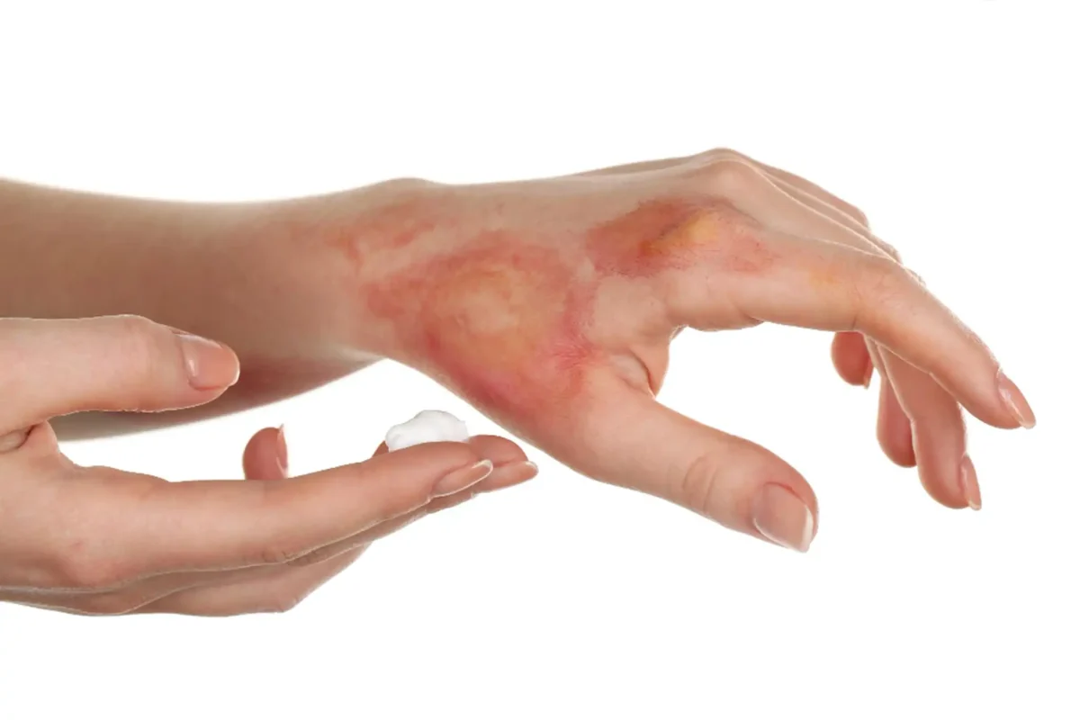 skin-burns-1200x800.webp